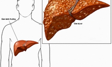 Một số chú ý sử dụng thuốc cho người suy gan